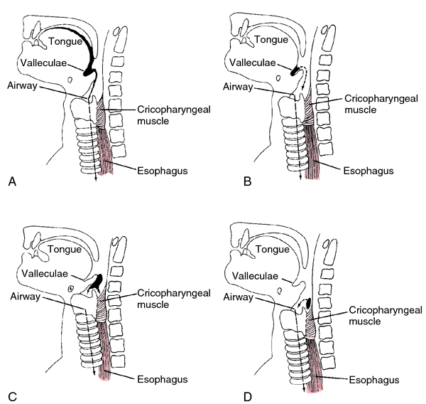 meconium-aspiration-definition-of-meconium-aspiration-by-medical