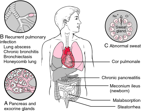 Cystic Fibrosis Cf Also Knows As Mucoviscidosis