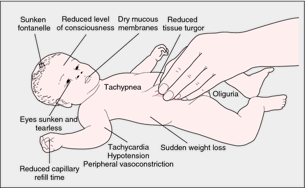 What are signs of dehydration?