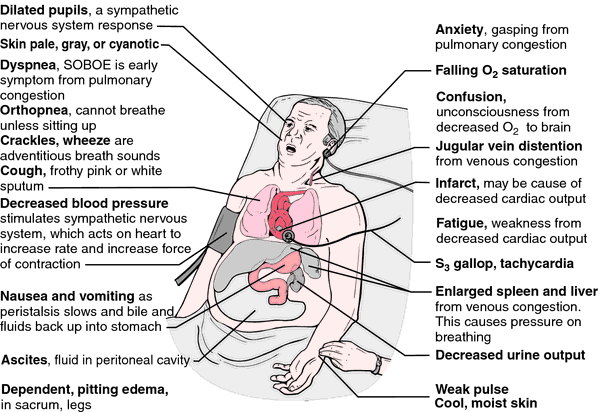 Heart InsufficiencyHigh-output heart failure secondary to arteriovenous fistula.