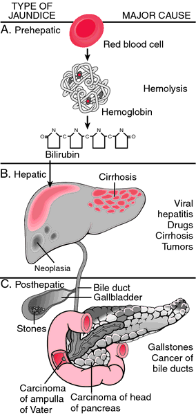 Prehepatic jaundice | definition of prehepatic jaundice by Medical