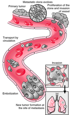 metastatic metastasis medical disease cascade definition occurs marked several steps 2000 through