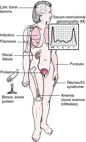 What are the stages of multiple myeloma?