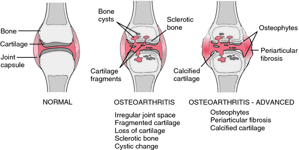 What are the early signs of osteoarthritis?