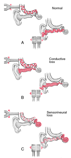 weber test positive