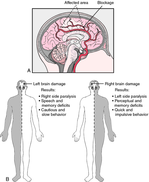 What could cause a stroke in the brain?