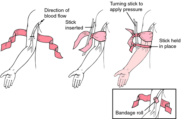 how to apply a tourniquet