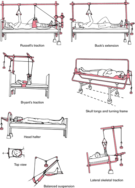 What is balanced suspension traction?