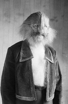 Stephan Bibrowski, a famous person with hypertrichosis