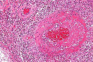 Churg-Strauss syndrome - high mag.jpg