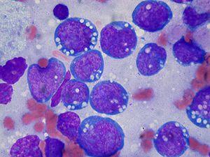 Burkitt lymphoma, touch prep, Wright stain.jpg