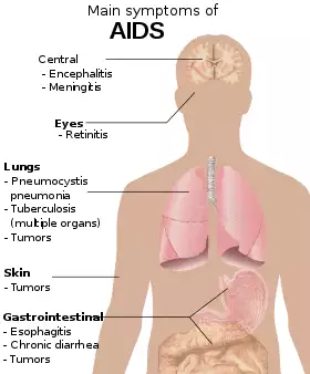 A diagram of a human torso labelled with the most common symptoms of AIDS