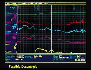 Bladder Sphincter Dyssynergia Urodynamic Trace.jpg