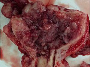 Cancer uteri.jpg