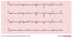 E312 (CardioNetworks ECGpedia).jpg