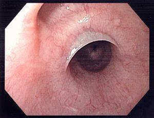 Esophageal web.jpg