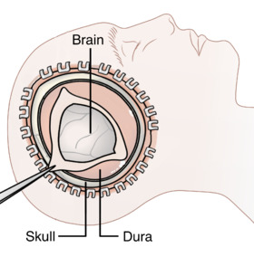 Decompressive Craniectomy.png