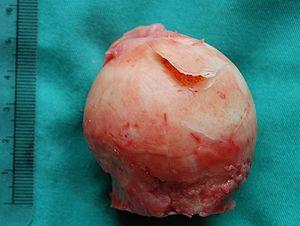 Head of femur avascular necrosis.jpg