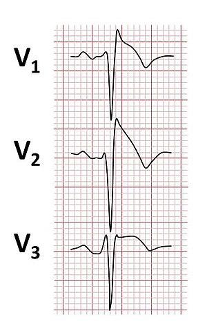 Brugada syndrome ECGs.jpg