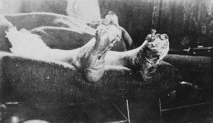 Case of trench feet suffered by unidentified soldier Cas de pieds des tranchées (soldat non identifié).jpg