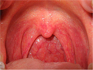 Pharyngitis.jpg