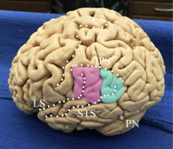 Superficial anatomy of the inferior parietal lobule (IPL).png