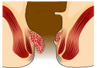 Piles Grade 2.svg