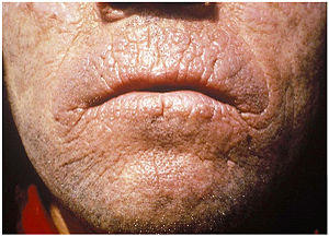 Chronic skin lesions of EPP.jpg