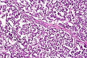Dysgerminoma, high mag.jpg
