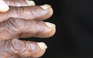 Koilonychia iron deficiency anemia.jpg