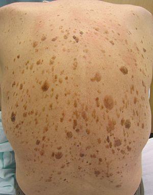 Seborrheic keratosis on human back.jpg