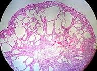 Fundic Gland Polyp, Stomach (3295692096).jpg