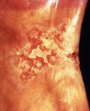 NIH DOC 19 Erythroleukoplakia.jpg