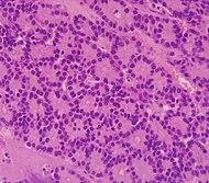 Histopathology of acinar cell carcinoma of the pancreas.jpg
