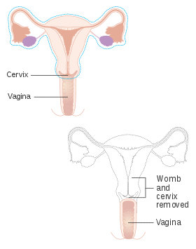 Diagram showing parts of the body removed with a radical hysterectomy CRUK 180.svg