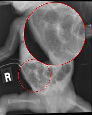 Necrotizing enterocolitis 202.jpg