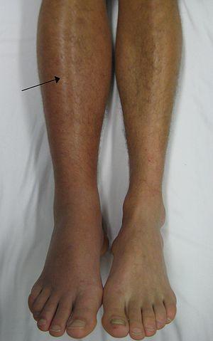 Deep vein thrombosis of the right leg.jpg