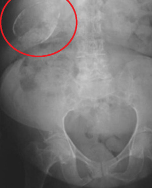 Porcelain gallbladder.png