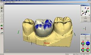 CEREC-krona.jpg