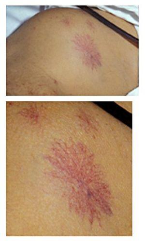 Spider nevus.jpg