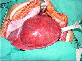 Liver lobectomy 02.jpg