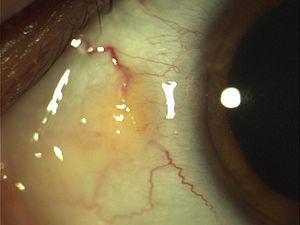 PRE-OPERATIVE PINGUECULA.JPG