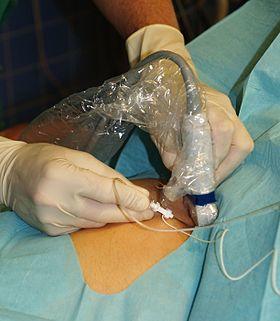 Fermoral nerve block.jpg