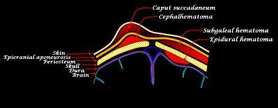 Scalp hematomas.jpg