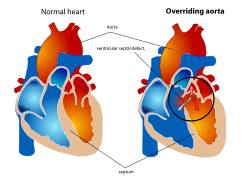 Overriding aorta diagram.svg