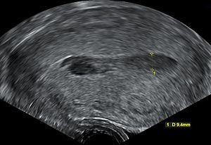 Hematometra - postpartum.jpg