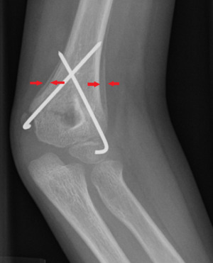 Periosteal reaction by a supracondylar fracture.png