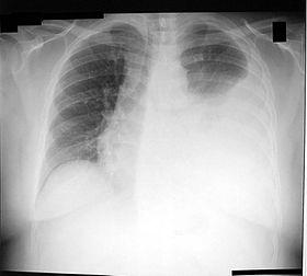 Left-sided Pleural Effusion.jpg