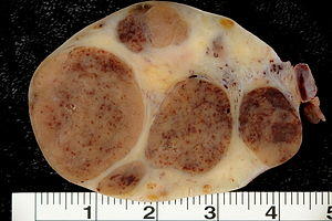 Luteoma-of-pregnancy.jpg