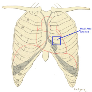 Precordial catch syndrome Area.png
